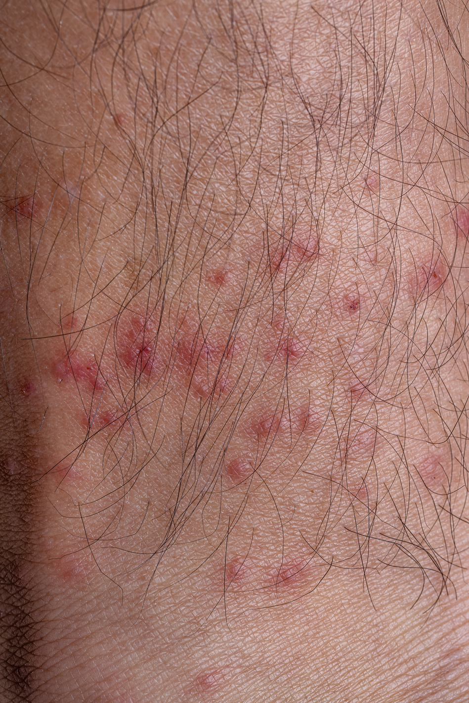 allergic reactions to tick bites